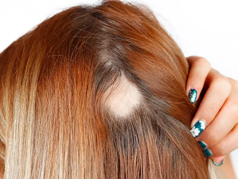 Natuprost ajuda na prevenção da queda do cabelo