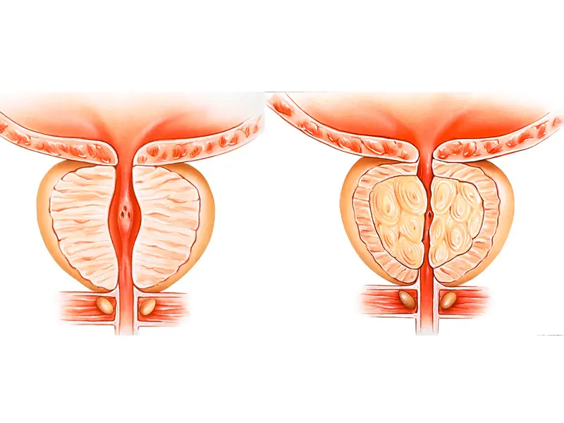 Natuprost ajuda na prevenção do cancer de prostata