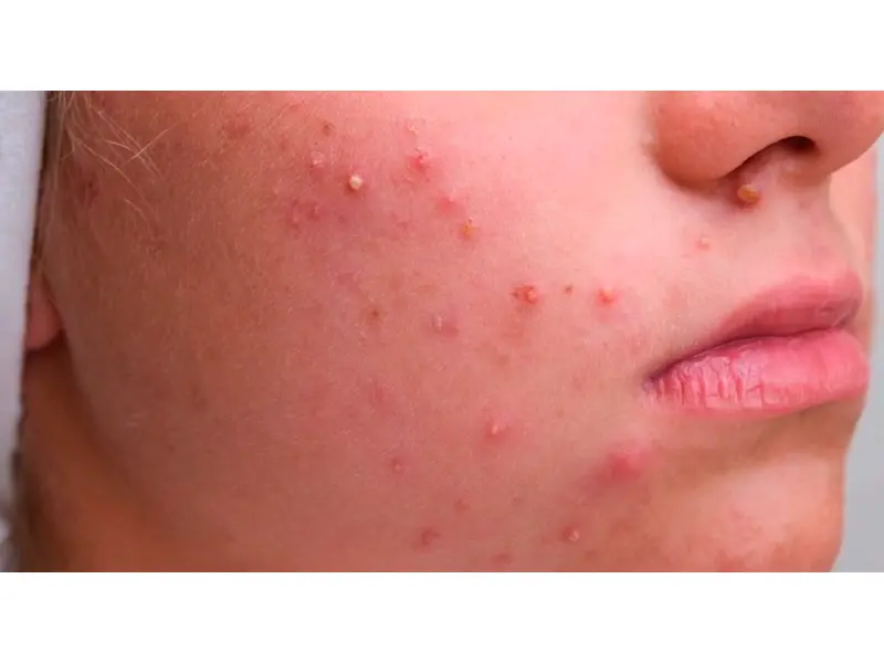 Natuprost combate acne